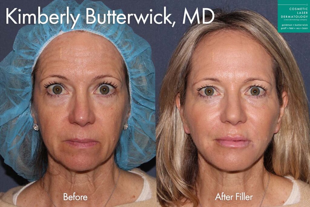 juvederm filler results